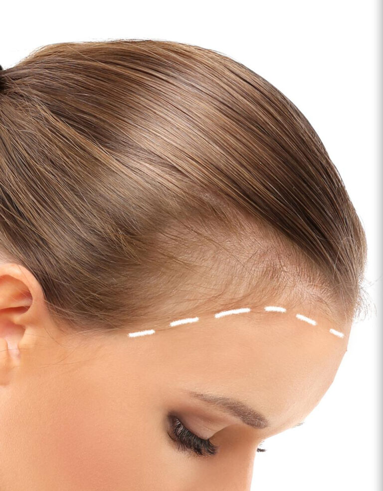 przerzedzenie-wlosow-i-wypadanie-wlosow-lysienie-typu-zenskiego-przeszczep-wlosow